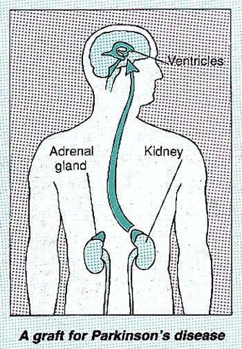 A graft for Parkinson's disease