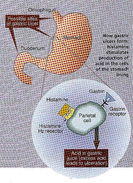 How gastric ulcers form