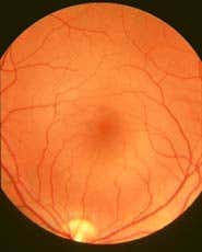 Retinal photographs pinpoint people at high stroke risk