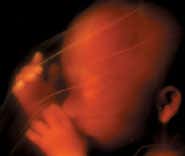 Amniotic fluid could heal newborn babies