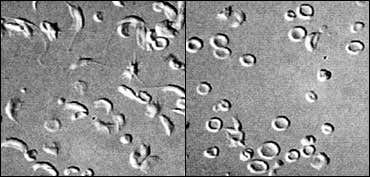 Sickle cell treatment marks gene therapy milestone