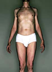 Ultrasound used for blood-free vasectomies