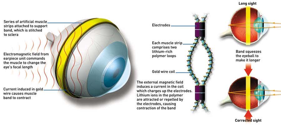 Eyeball squeezing could correct sight
