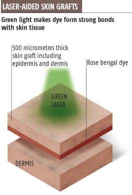Laser-activated glue attaches skin grafts