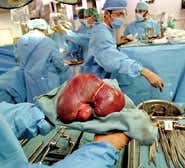 Out-of-body operation banishes tumours