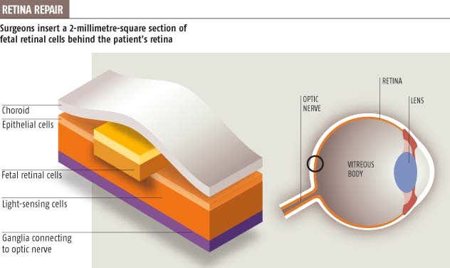 Retina repair