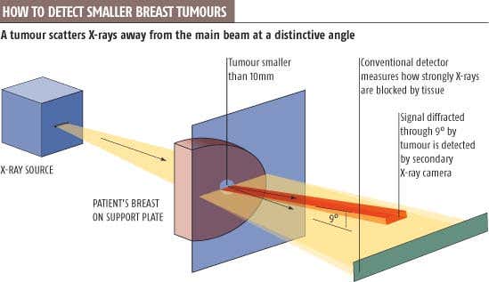 X-ray trick picks out tiny tumours