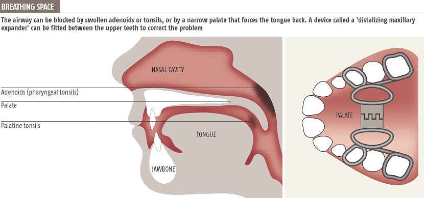 Bed-wetters could breathe easier