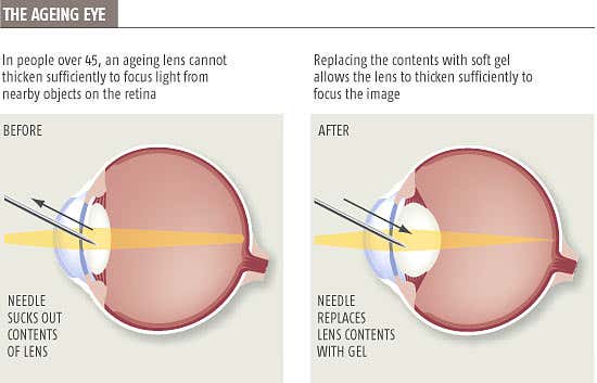 Jelly lenses could fix ageing eyes