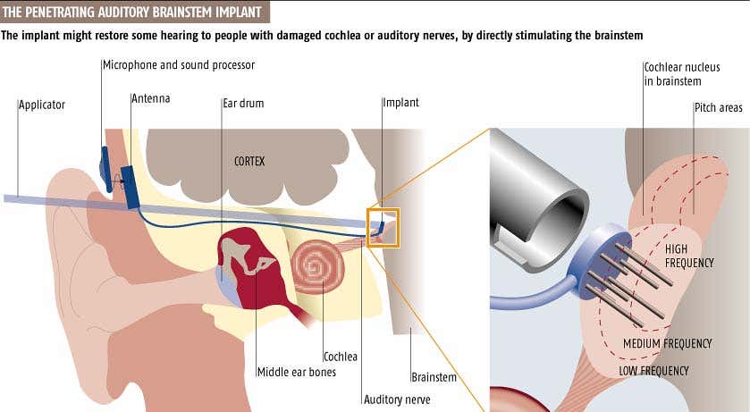 First brainstem implants aim to tackle deafness