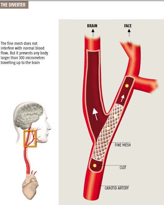 Tea strainer in the neck 'stops strokes'