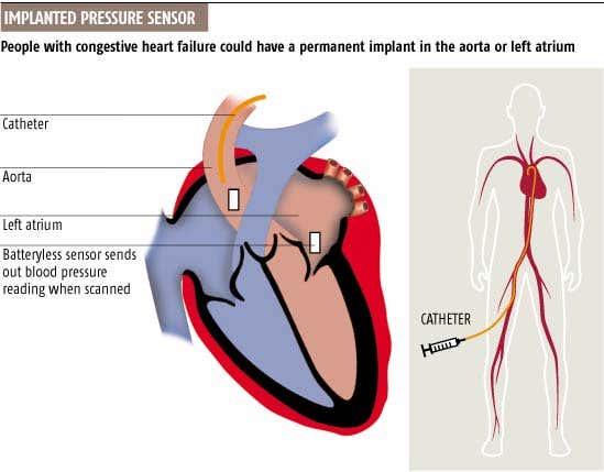 Batteryless implant measures blood pressure in heart