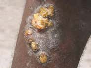 Flesh-eating disease threatens Congo's pygmies