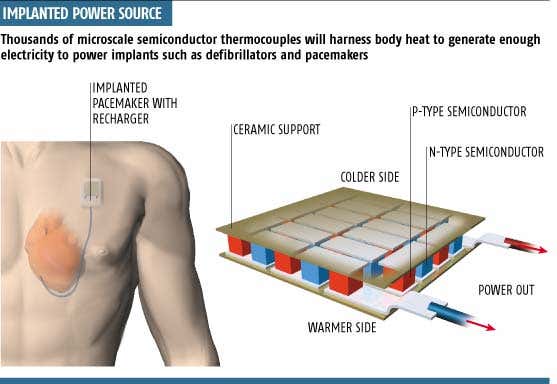 Power implant aims to run on body heat