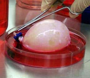 Bio-engineered bladders successful in patients