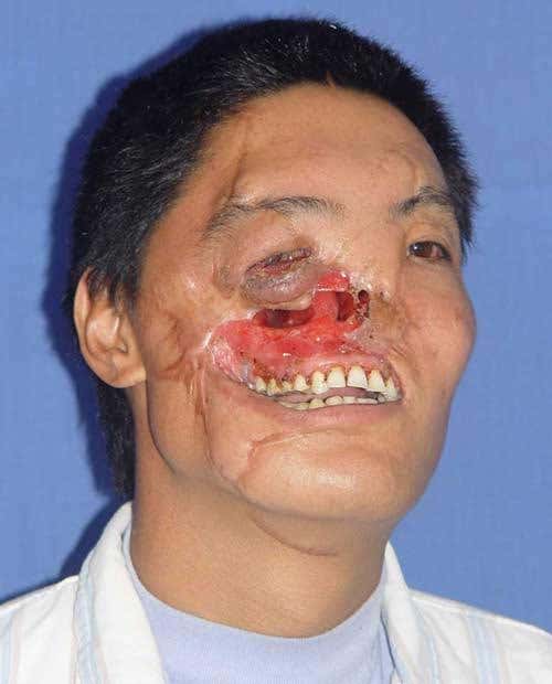 World's second face transplant performed in China