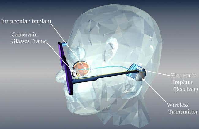 Better 'bionic eye' offers new hope of restored vision