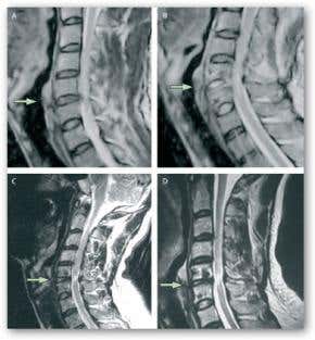 Donor discs used to treat back disorders