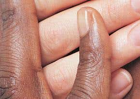 Skin colour: cracking the genetic code