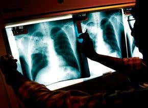 Extreme TB: the white plague