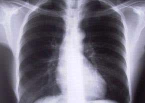 A slimming treatment for artificial lungs