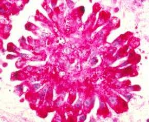 'Cancer-resistant' people lend out their killer cells