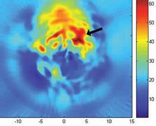 Laser beams to the brain reveal seizures in real time