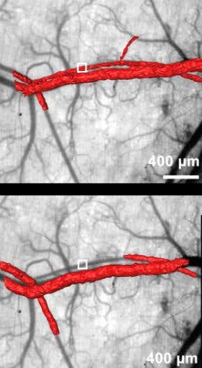 Laser-sensitive drug seals blood vessels in a flash