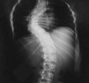 Spinal implant grows with the patient