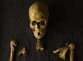 Gallery: Old bones reveal historical health problems