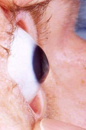 Invention: Eyeball stiffener