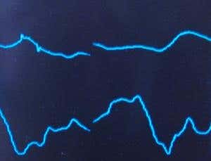 Rechargable pacemaker tops up with every heartbeat