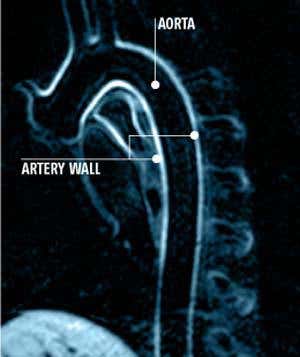 Image that artery: MRI scan of artery in healthy pig (Image: Lantheus Medical Imaging / René Botnar