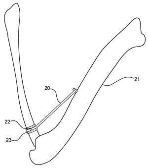 The artificial muscles could also be used to reanimate paralysed limbs, by installing them alongside a persons own atrophied muscles
