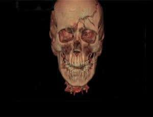 Virtual autopsy: Inside the skull of a suicide victim
