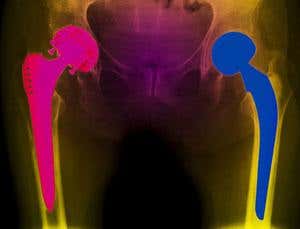 Sporty joint implants could go the distance