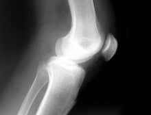 Artificial cartilage performs better than the real thing