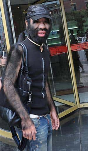 'Wolf man' condition down to huge DNA malfunction