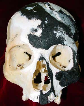 The upper skull is usually the most charred part of the skeleton, because it has little overlying soft tissue