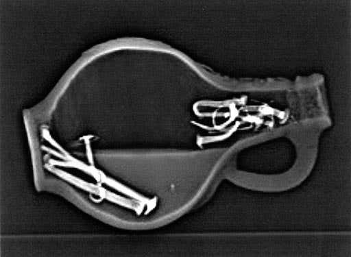 CT scan of the Greenwich bottle, showing human urine, pins and nails, with cork just visible