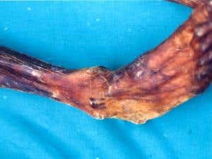 Tattoo lines on the right leg of the Tyrolean iceman, Ötzi.   