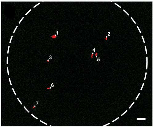 Fluorescent mobile phone microscopy image of tuberculosis in sputum. The cells are automatically counted using the cellphone's software 