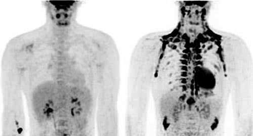 In this PET-CT scan Brown fat (black) shows up after exposure to cold (right) but is not apparent in a scan at room temperature (left).