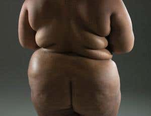 Full without food: Can surgery cure obesity?