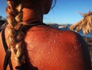 Pain molecule find could take the sting out of sunburn