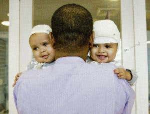 How did surgeons separate conjoined twins?