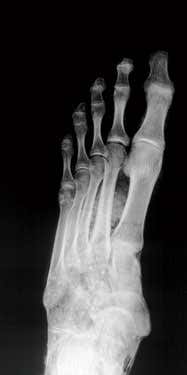 X-ray of foot