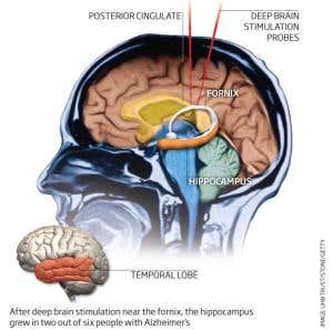 Alzheimer's damage reversed by deep brain stimulation