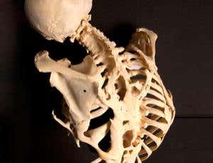 The disease that turns you to stone