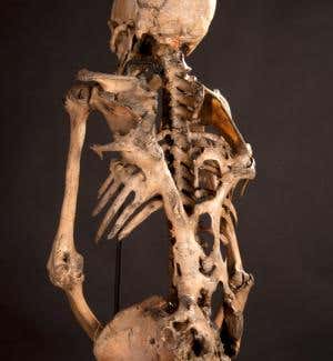 Relentless growth of rogue bones locks people in place